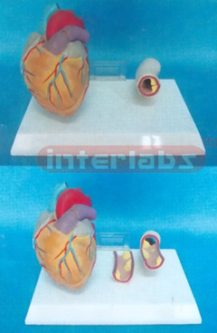 MIDDLE HEART MODEL WITH DISEASE BLOOD TUBE